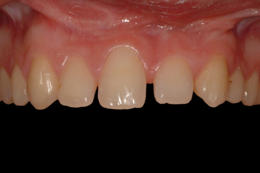 Paciente con agenesia dental