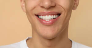 Requisitos para ponerse carillas dentales