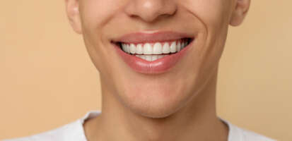 Requisitos para ponerse carillas dentales