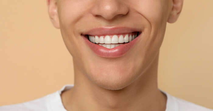 Requisitos para ponerse carillas dentales