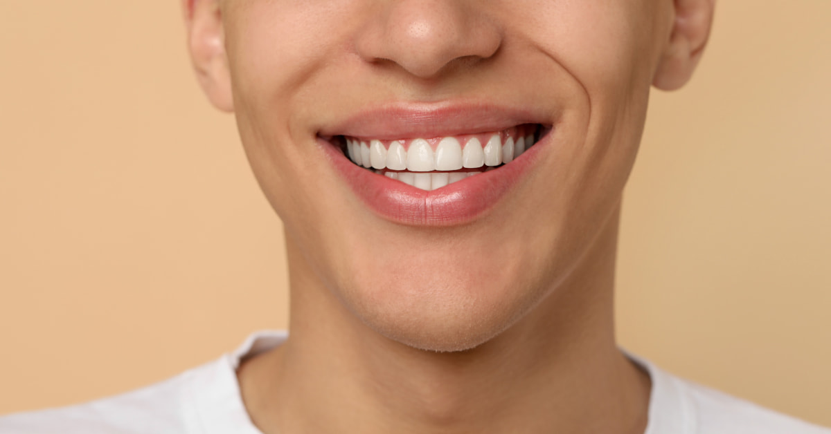 Clínicas Den - 6 Requisitos para ponerse carillas dentales. ¿Eres un buen candidato?