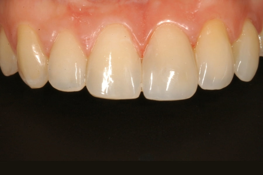 Tratamiento de carillas y ortodoncia para agenesia