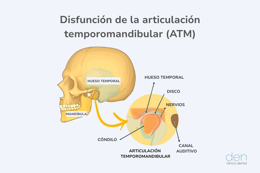 Disfunción ATM