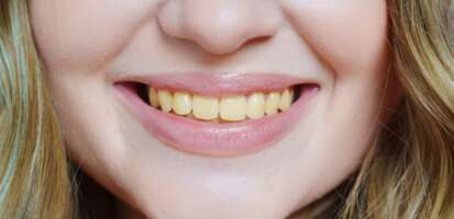 Cúrcuma amarillea los dientes