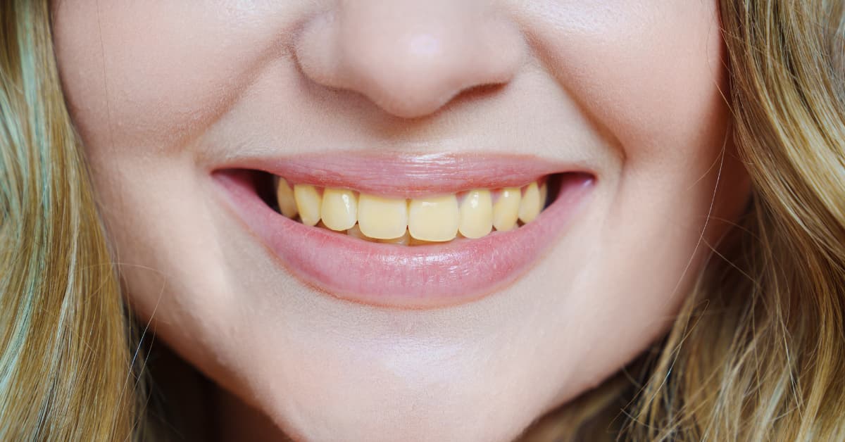Clínicas Den - La cúrcuma amarillea los dientes, ¿por qué ocurre y cómo evitar las manchas? Clínicas Den - La cúrcuma amarillea los dientes, ¿por qué ocurre y cómo evitar las manchas?
