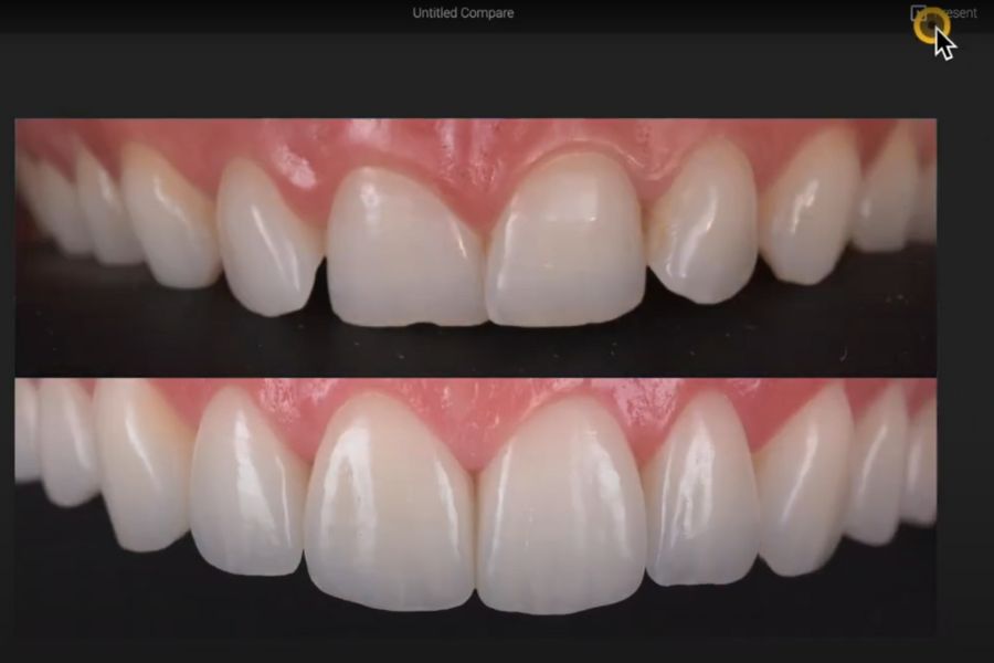 Antes y después de la sonrisa en Smilecloud