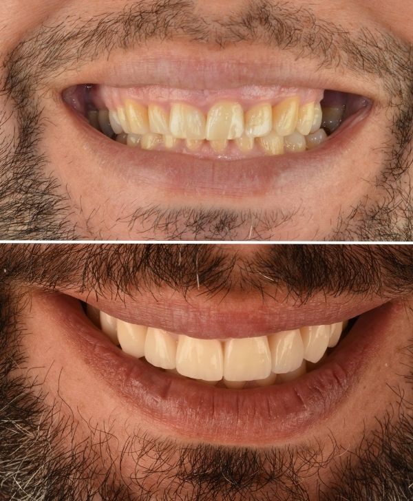 Antes y después del tratamiento de bruxismo desgaste dental