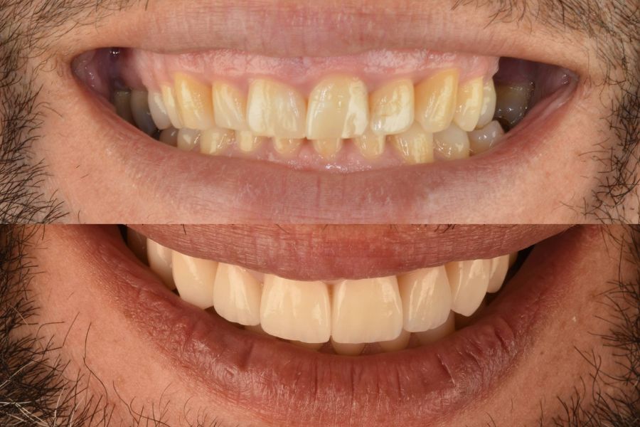 Antes y después del tratamiento para corregir sonrisa gingival, falta de molar superior y ausencia de oclusión funcional