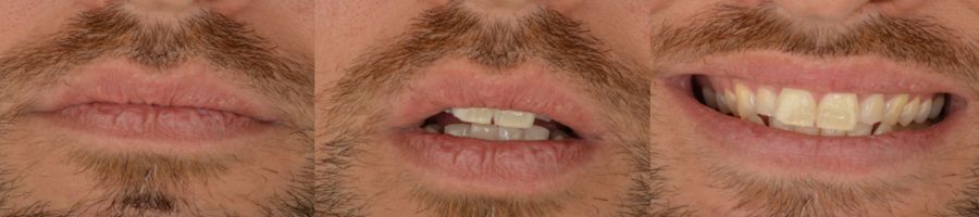 Estado inicial de la boca de Daniel