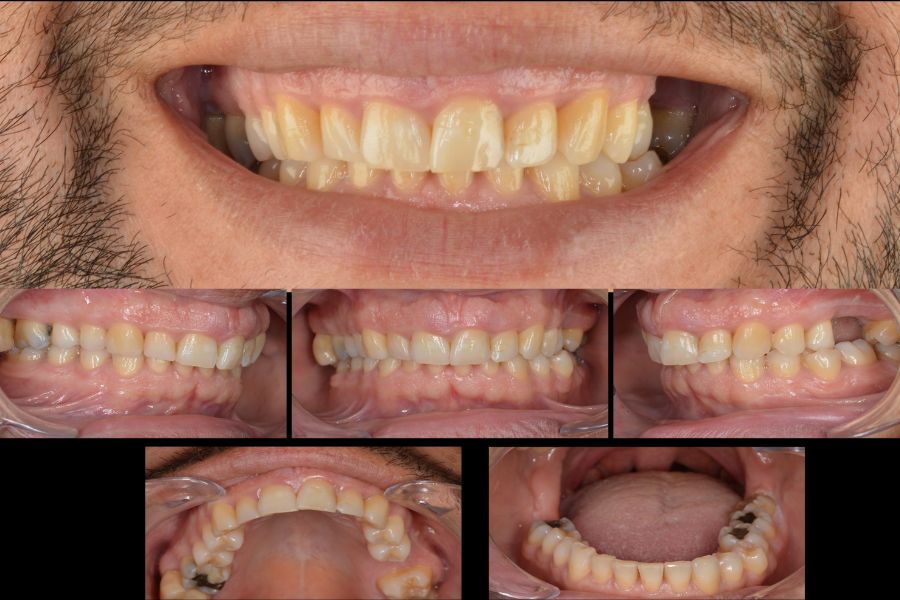 Estado inicial de la boca del paciente