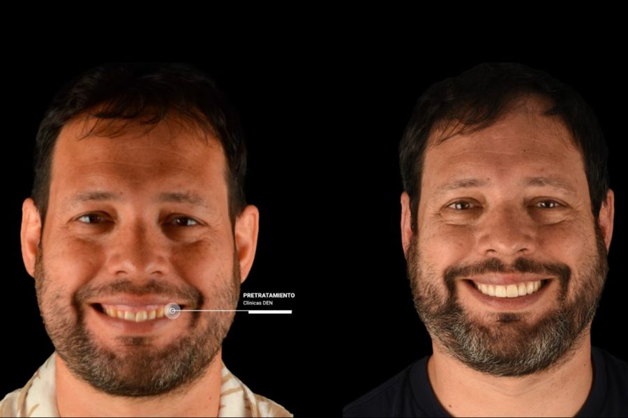 pre y post tratamiento desgaste dental