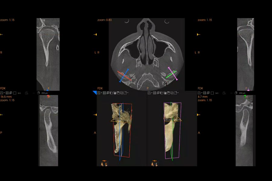 Prueba 3D CBCT dental