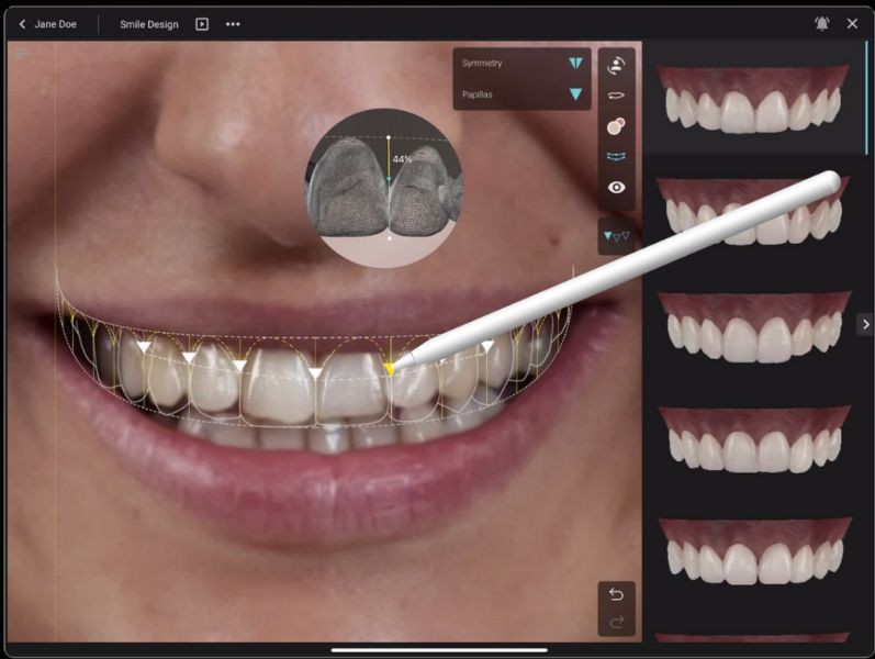 Smile design con Smilecloud