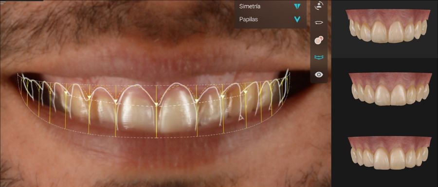Smilecloud - Software IA de diseño de sonrisa