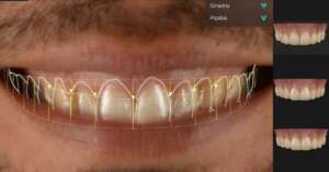 ¿Qué es Smilecloud y cómo la tecnología de IA beneficia a los pacientes de nuestra clínica? Smilecloud tecnología de Clínicas Den