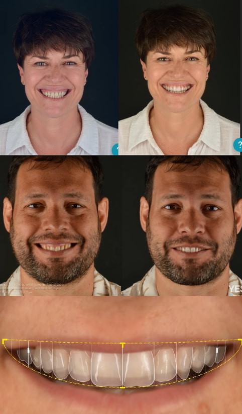 Visualización antes y después previo al tratamiento - Smilecloud