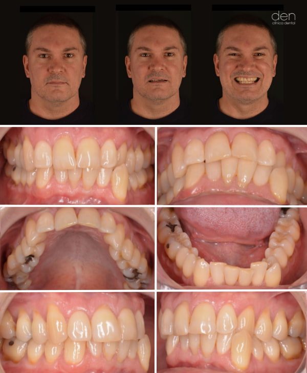 Paciente con mordida cruzada y apiñamiento dental