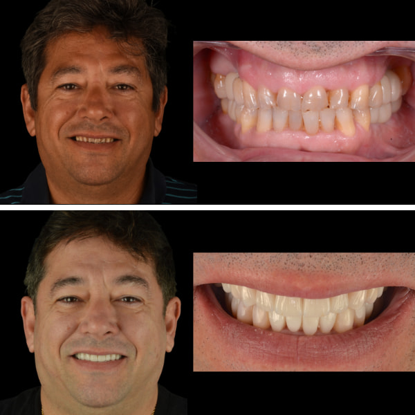 Antes y después de una mordida borde a borde
