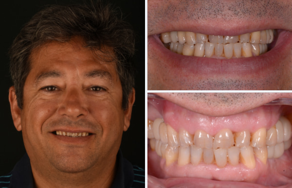 Apariencia de una mordida borde a borde y desgaste dental