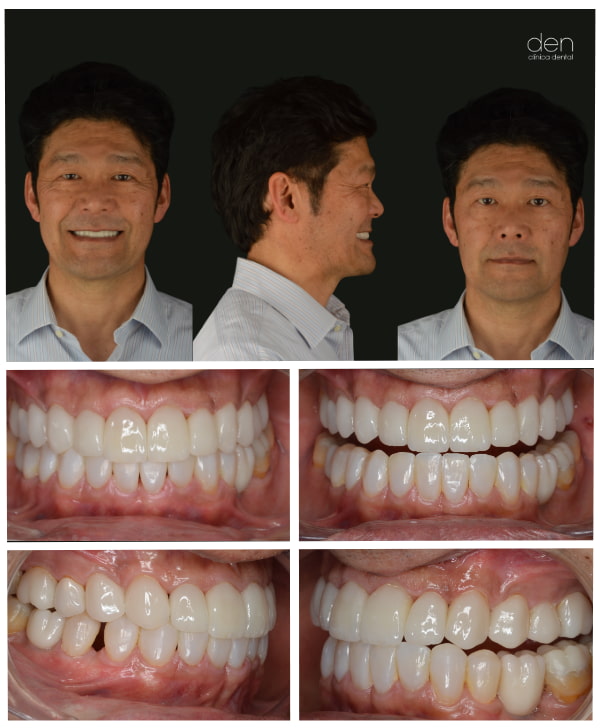 Boca final con estética dental