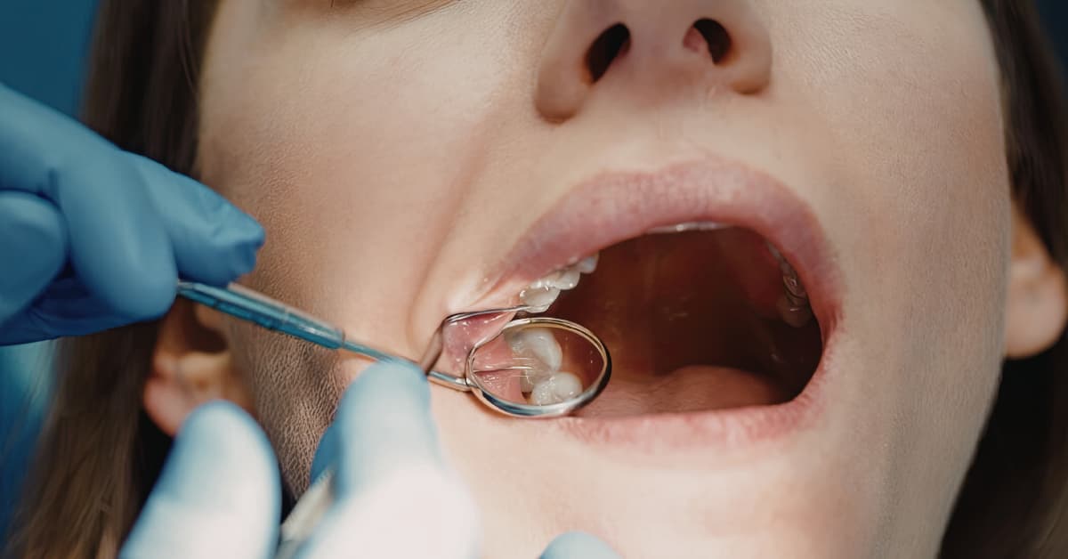 Clínicas Den - Rehabilitación oral completa ¿qué es, cuándo la necesitas y cómo se hace? Clínicas Den - Rehabilitación oral completa ¿qué es, cuándo la necesitas y cómo se hace?