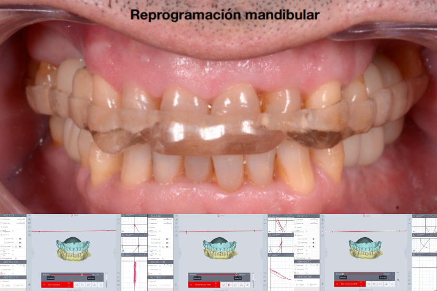 Reprogramación mandibular mordida borde a borde