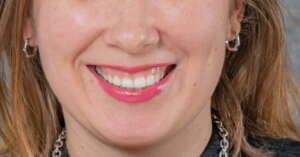 Sonrisa gingival antes y después ¡Casos reales de nuestra clínica dental en Barcelona! Sonrisa gingival antes y después
