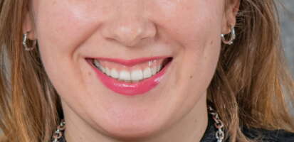 Sonrisa gingival antes y después