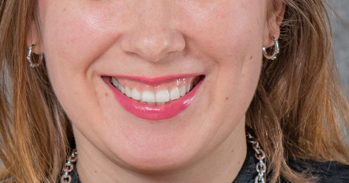 Clínicas Den - Sonrisa gingival antes y después ¡Casos reales de nuestra clínica dental en Barcelona! Clínicas Den - Sonrisa gingival antes y después ¡Casos reales de nuestra clínica dental en Barcelona!