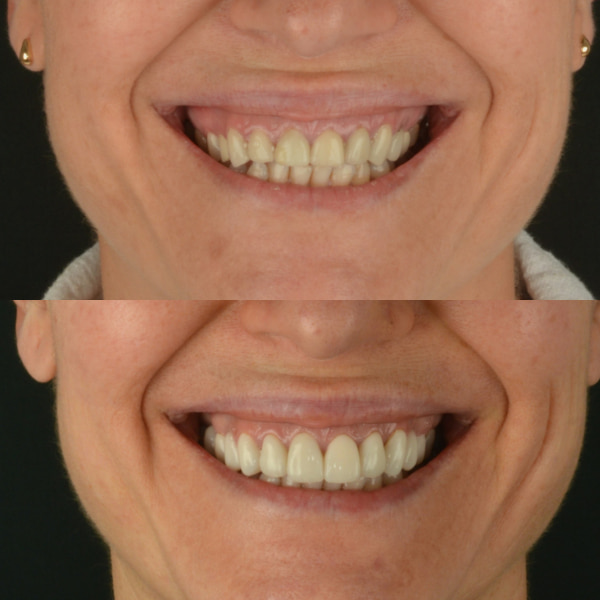 Sonrisa gingival en una rehabilitación oral completa