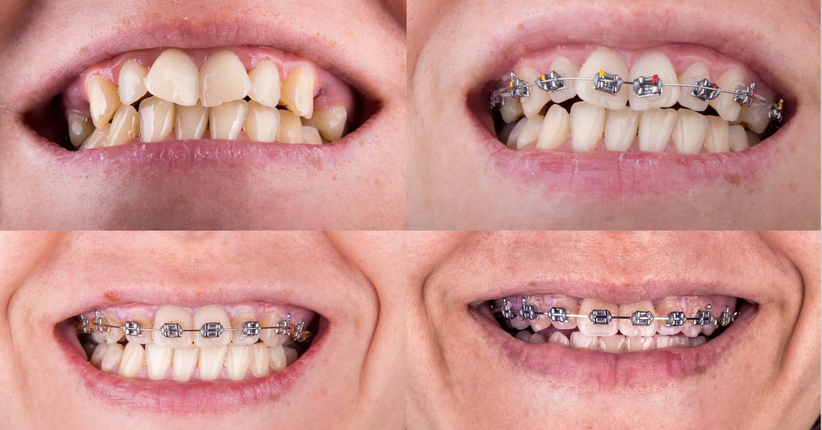 Clínicas Den - Ortodoncia antes y después: 12 casos clínicos de pacientes reales de Clínicas Den Clínicas Den - Ortodoncia antes y después: 12 casos clínicos de pacientes reales de Clínicas Den