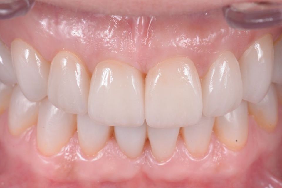 Dental veneers