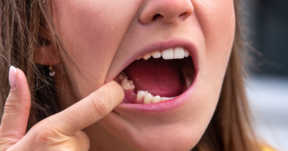 Clínicas Den - ¿La falta de muelas deforma la cara? 13 consecuencias de no tratar la pérdida dental Clínicas Den - ¿La falta de muelas deforma la cara? 13 consecuencias de no tratar la pérdida dental