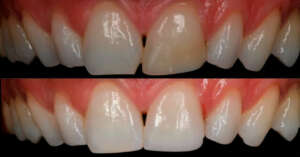 ¿Cuáles son las mejores carillas dentales y cuál te conviene más? Mejores carillas dentales - blanqueamiento y carillas composite.