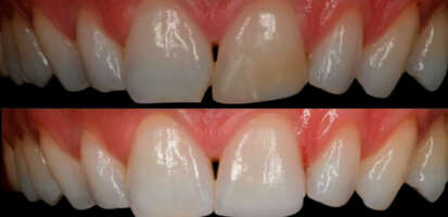 Mejores carillas dentales - blanqueamiento y carillas composite.