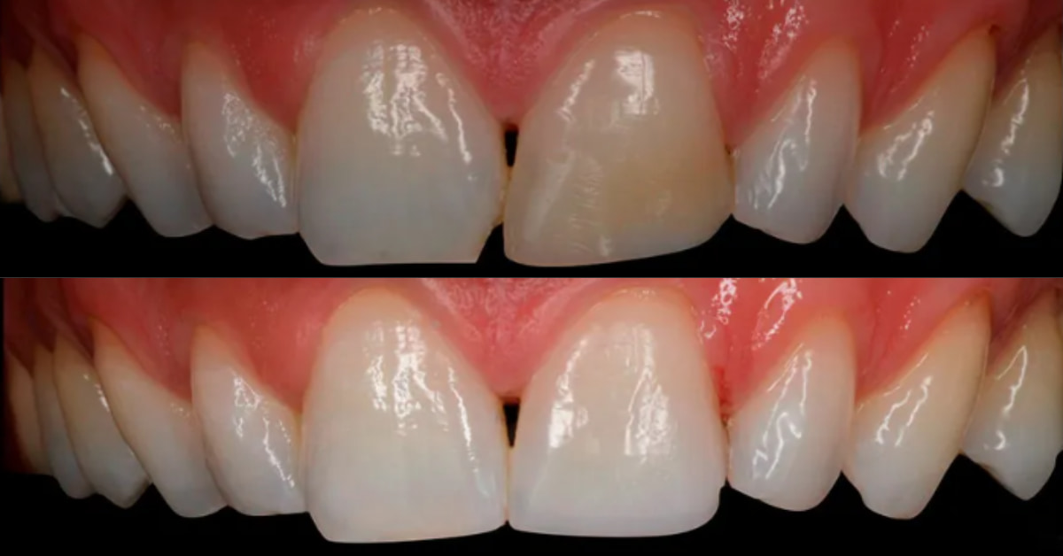 Clínicas Den - ¿Cuáles son las mejores carillas dentales y cuál te conviene más? Clínicas Den - ¿Cuáles son las mejores carillas dentales y cuál te conviene más?