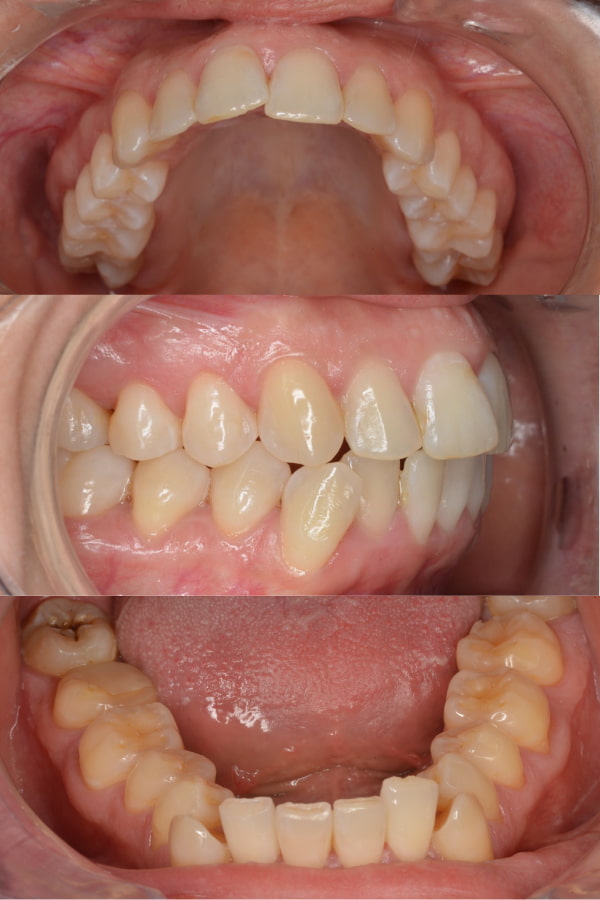 Apiñamiento dental y desviación mandibular