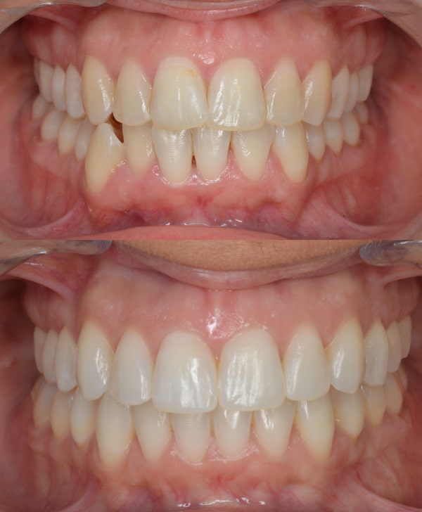 Antes y después de una desviación mandibular y dientes apiñados
