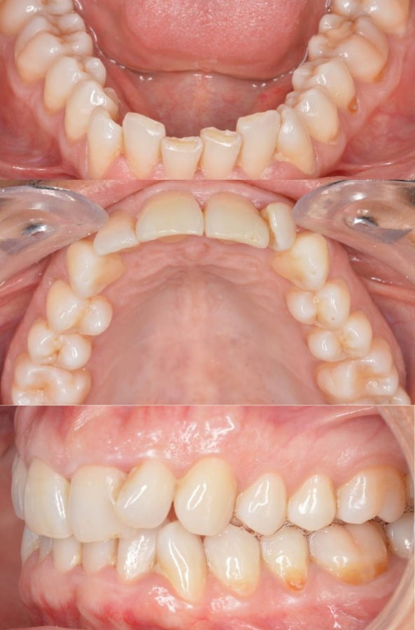 Malposición dental en ambas arcadas