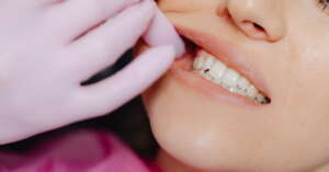 Recidiva ¿Qué significa y cómo evitarla en ortodoncia? Recidiva dental tras ortodoncia