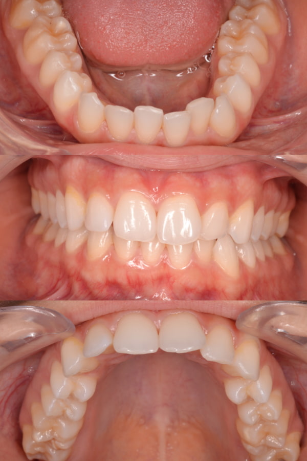 Recidiva dental tras ortodoncia