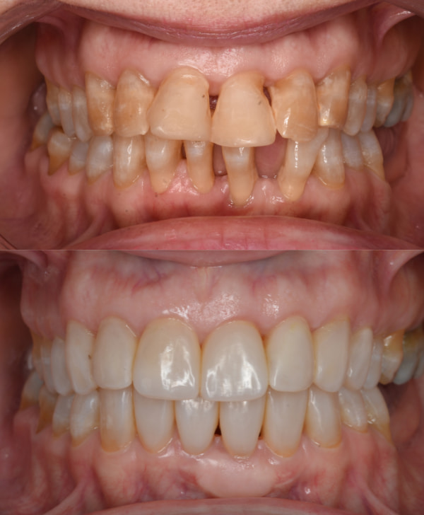 Antes y después de una boca con periodontitis y tratamiento de ortodoncia