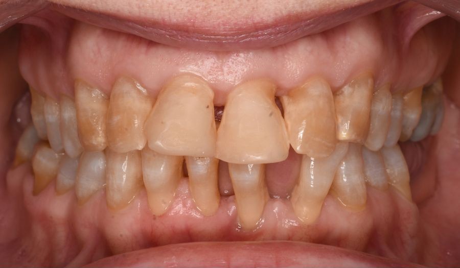 boca con enfermedad periodontal