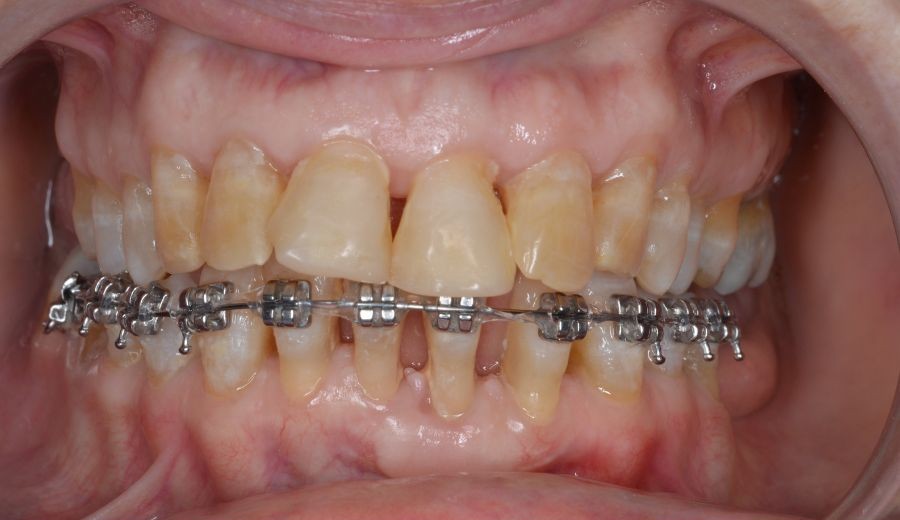 Boca tras frenar una enfermedad periodontal y un tratamiento de ortodoncia inferior
