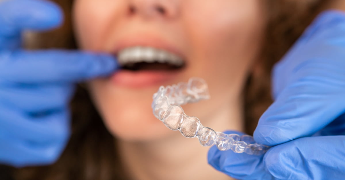 Clínicas Den - ¿Cómo alinear los dientes torcidos o apiñados sin brackets? Clínicas Den - ¿Cómo alinear los dientes torcidos o apiñados sin brackets?
